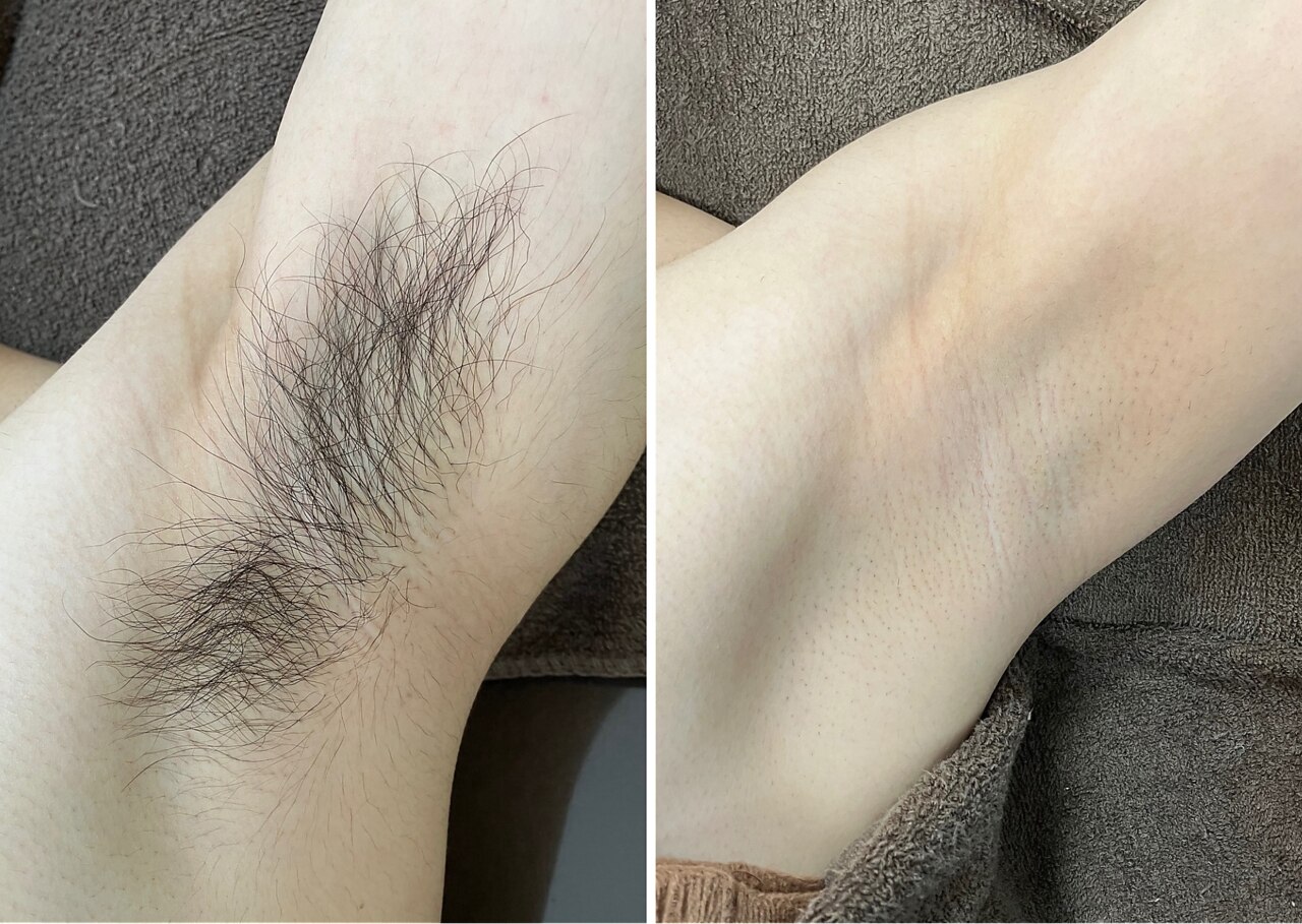 メンズヒゲ脱毛